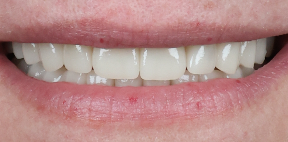 Close-up of a patient’s brighter and more even smile after cosmetic dental treatment – Rebecca Koenigsberg